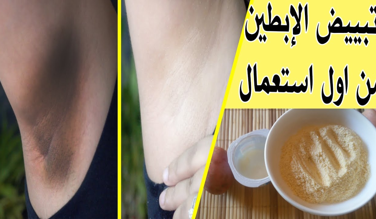 التخلص من اسمرار الإبط