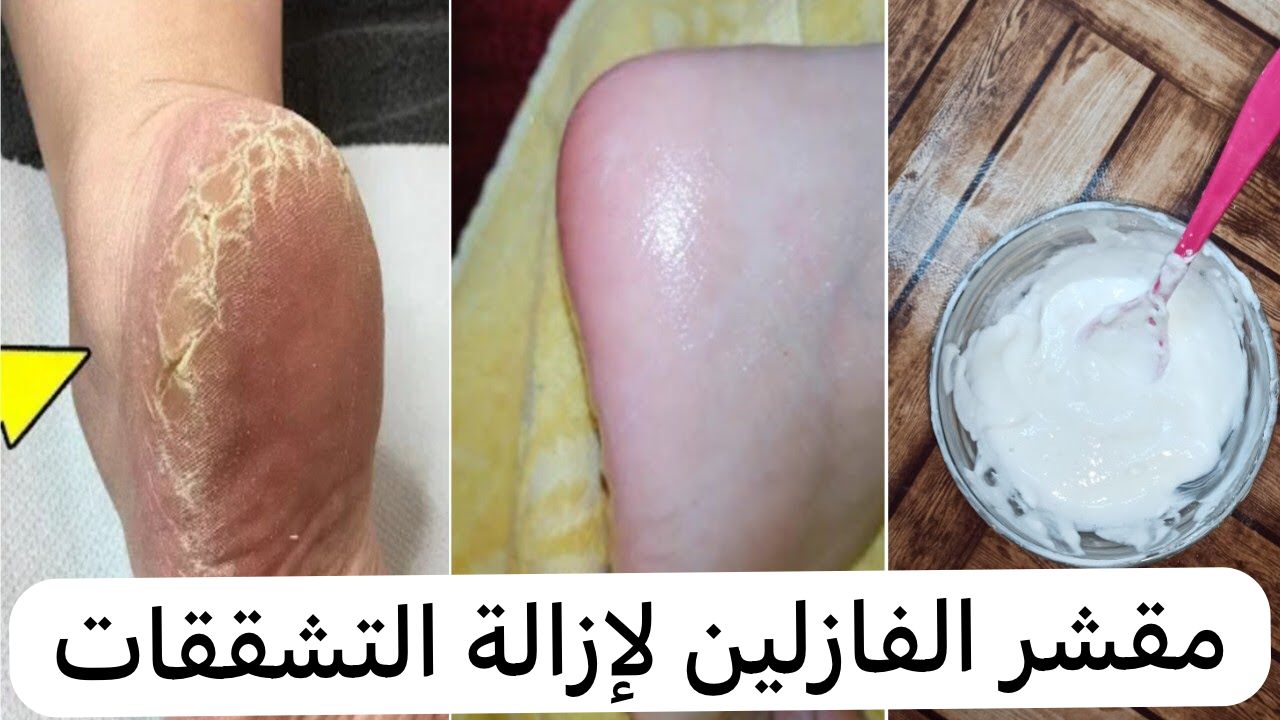 مقشر الفازلين لإزالة التشققات 